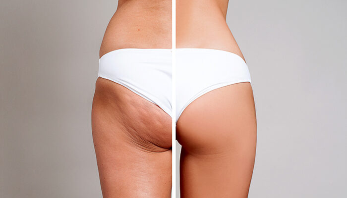 traitements anti-cellulite 2